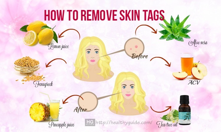 15 Tips How To Remove Skin Tags Quickly on Face and Body