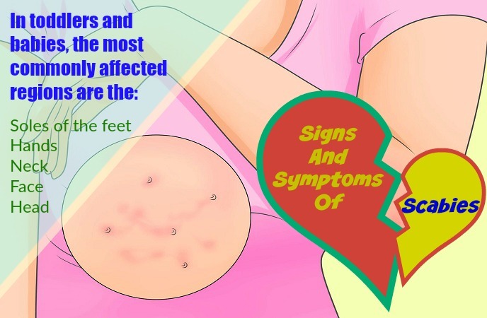 home-remedies-for-scabies-signs-and-symptoms-of-scabies