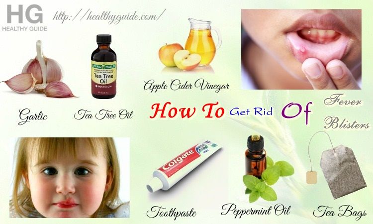 30 Tips How to Get Rid of Fever Blisters on Face, Tongue, Lip, & Mouth