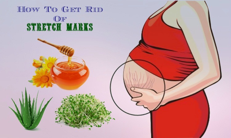 25 Tips How to Get Rid of Stretch Marks Fast and Naturally