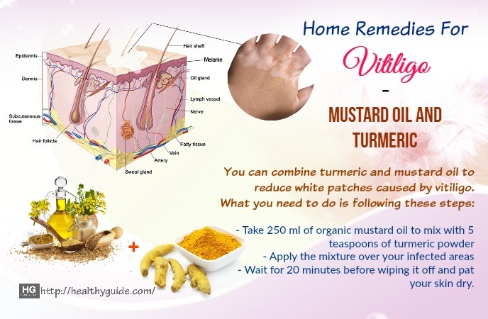 Home Remedies For Vitiligo 