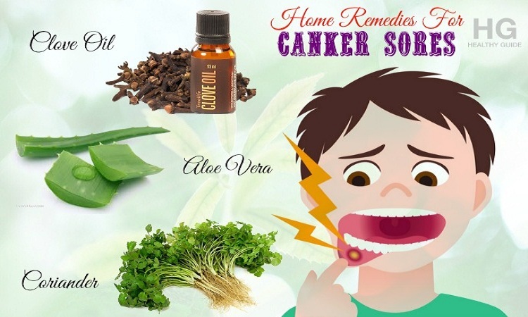 20 Home Remedies For Canker Sores On Tongue, Gums And In Throat