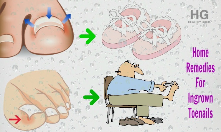 19 Natural Home Remedies for Ingrown Toenails Infection