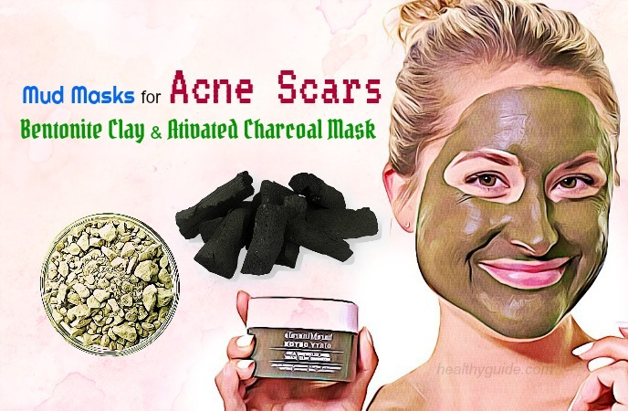 mud masks for acne 