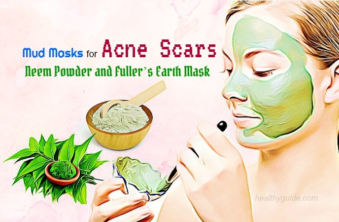 mud masks for acne