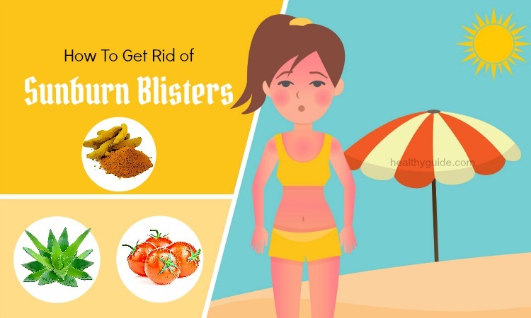 20 Tips How to Get Rid of Sunburn Blisters on Nose, Face, Lips, & Skin Fast