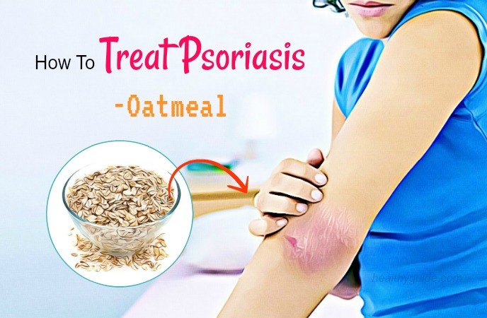 how to treat psoriasis 