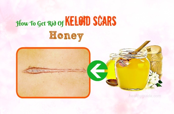 how to get rid of keloid scars 