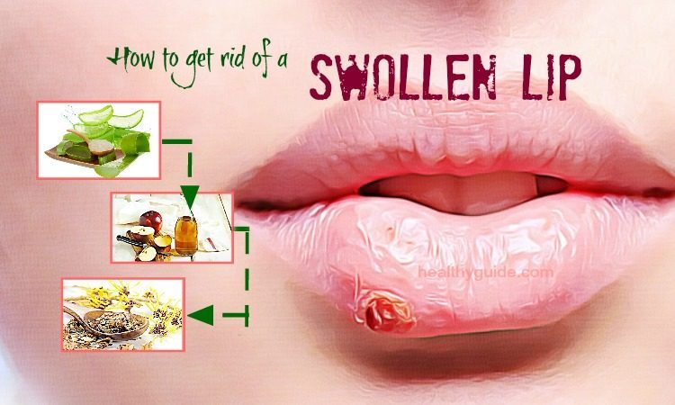 22 Tips How To Get Rid Of A Swollen Lip From A Cold Sore