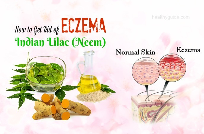 how to get rid of eczema 