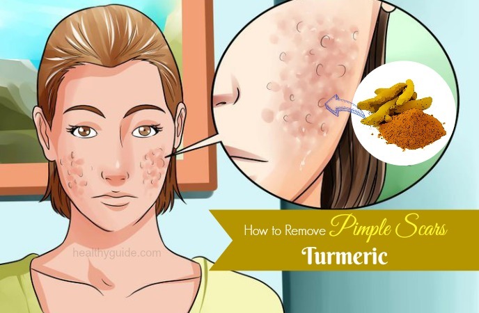 how to remove pimple scars