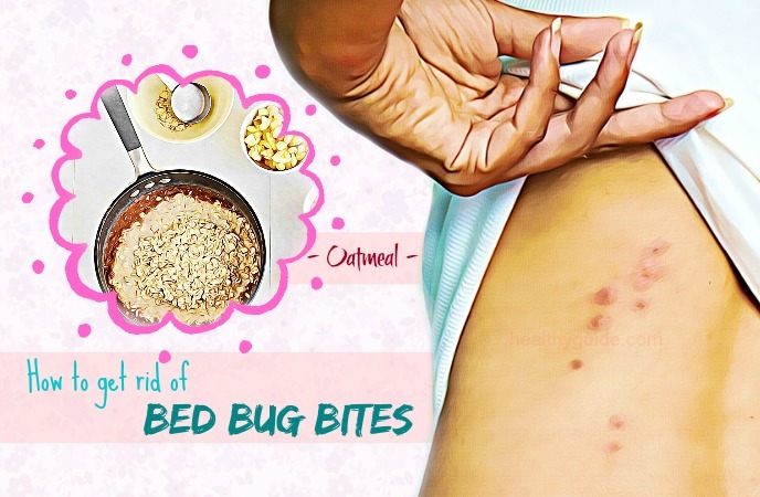 how to get rid of bed bug bites