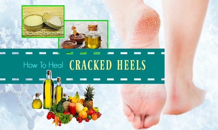 24 Remedies How to Heal Cracked Heels in Winter Overnight