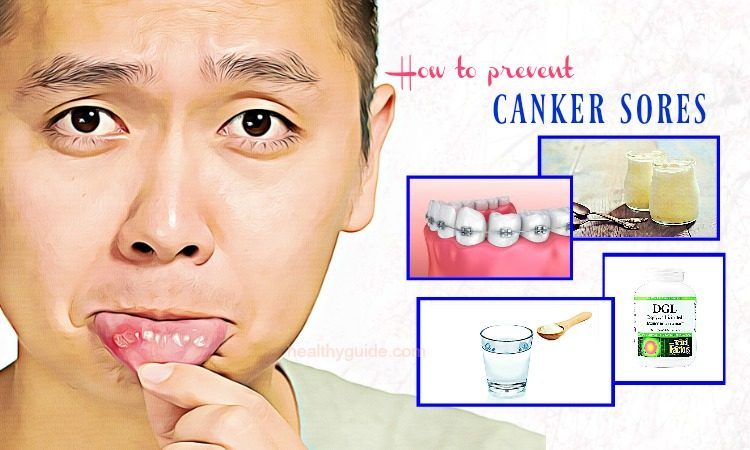 How to prevent a canker sore
