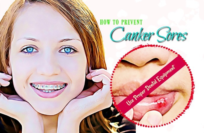 how to prevent canker sores
