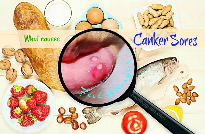 what causes canker sores