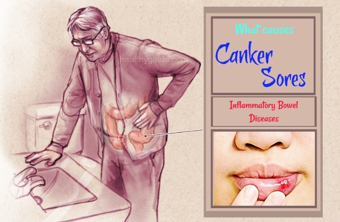 what causes canker sores