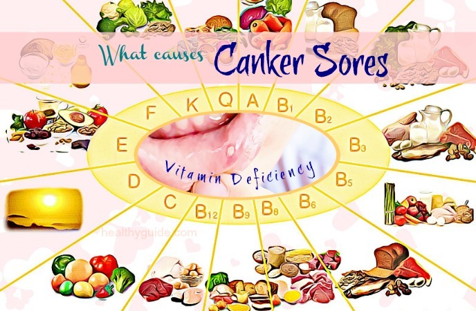 what causes canker sores- vitamin deficienc