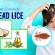 Natural Home Remedies for Head Lice – Top 13 Simple Ways