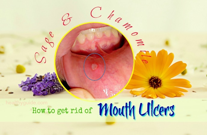 how to get rid of mouth ulcers 