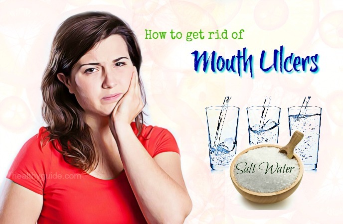 how to get rid of mouth ulcers