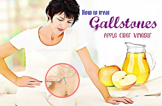 how to treat gallstones