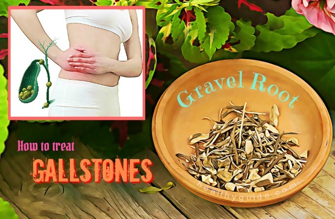how to treat gallstones
