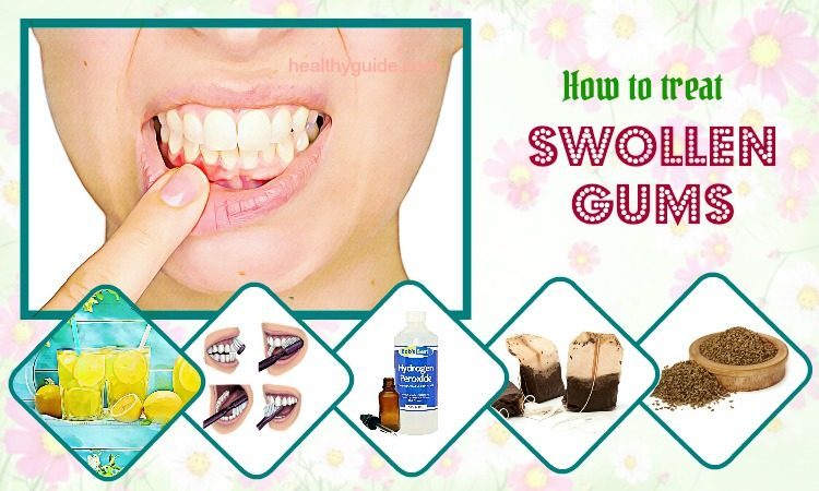 34 Tips How To Treat Swollen Gums Around Tooth And Cheek Fast