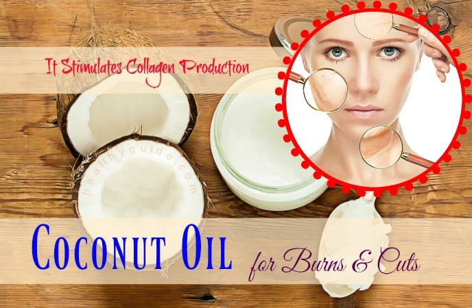 coconut oil for burns and cuts