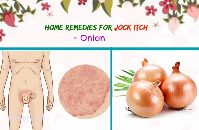 home remedies for jock itch