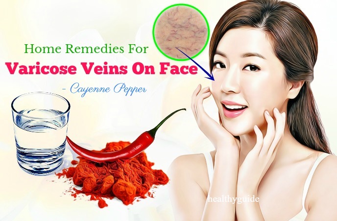 home remedies for varicose veins 