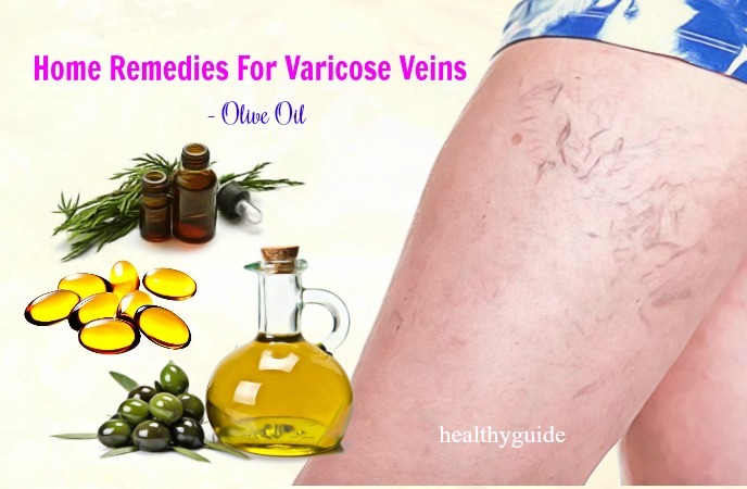home remedies for varicose veins