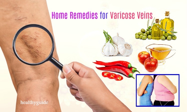 21 Natural Home Remedies for Varicose Veins Pain on Face & in Feet, Legs