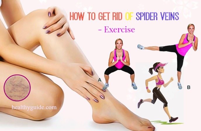 how to get rid of spider veins 