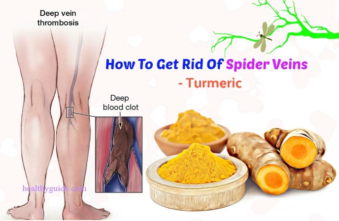 how to get rid of spider veins 