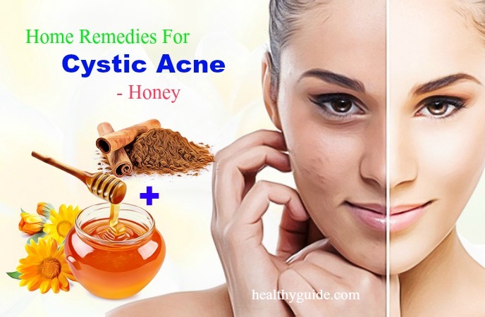 home remedies for cystic acne 