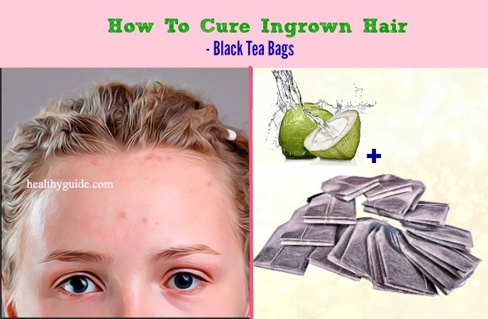 how to cure ingrown hair 