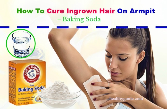 how to cure ingrown hair 