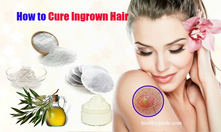 13 Tips How to Cure Ingrown Hair Infection on Face, Scalp, Armpit, in Legs