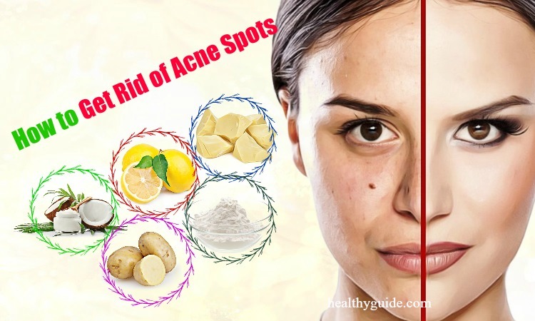 13 Tips How to Get Rid of Acne Spots on Face, Back, Arms, & Chest Overnight