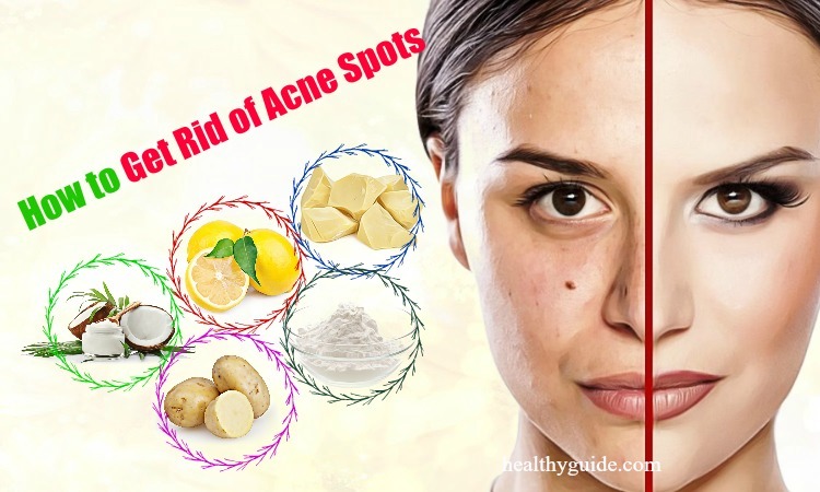 Tips How To Get Rid Of Acne Spots On Face Back Arms Chest Overnight