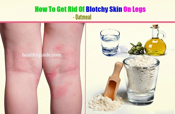 how to get rid of blotchy skin 