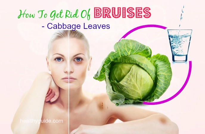how to get rid of bruises 