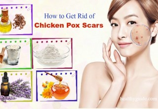 23 Tips How to Get Rid of Chicken Pox Scars on Face Fast, Naturally in a Week