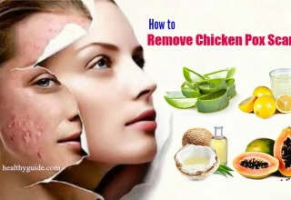 20 Tips How to Remove Chicken Pox Scars on Face Skin Naturally after a Week