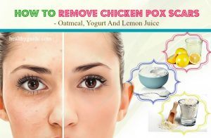 20 Tips How to Remove Chicken Pox Scars on Face Skin Naturally after a Week
