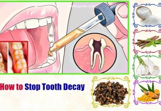 10 Tips How to Stop Tooth Decay Pain at Gum Line in Babies, Toddlers, Adults