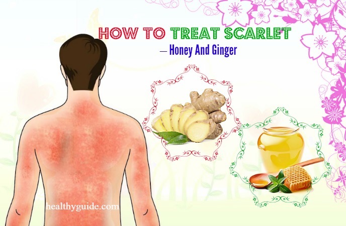 10 Tips How to Treat Scarlet Fever Rash, Itch, Peeling in Babies & Adults