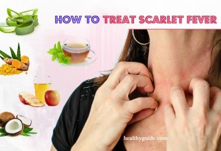 10 Tips How to Treat Scarlet Fever Rash, Itch, Peeling in Babies & Adults