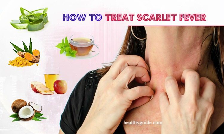 10 Tips How To Treat Scarlet Fever Rash Itch Peeling In Babies Adults   How To Treat Scarlet Fever 750x450 